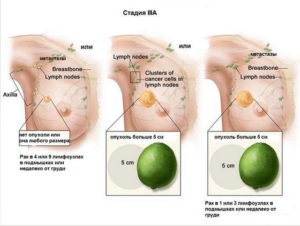 Третья стадия рака молочной железы
