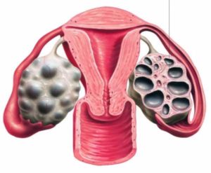 Поликистоз яичников психосоматика