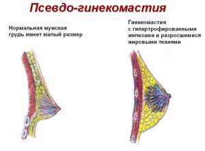 Гипомастия молочной железы