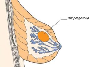 История болезни фиброаденома молочной железы