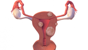 Можно ли забеременеть при эндометриозе и миоме матки