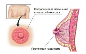 Педжета болезнь молочной железы