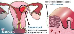 Гиперплазия эндометрия и эндометриоз это одно и то же