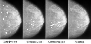 Олеогранулема молочной железы