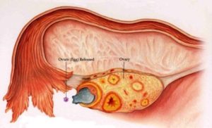 Не выходит яйцеклетка из яичника причины
