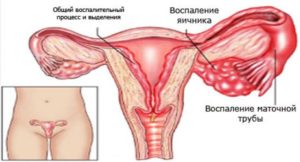 Болезни яичников у женщин симптомы