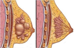 Что такое киста в молочной железе и чем она опасна
