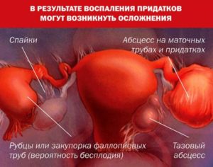 При воспалении яичников могут быть месячные