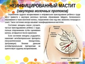 Закупорка протока молочной железы