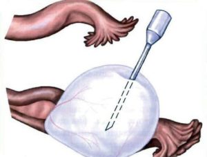 Цистэктомия яичника