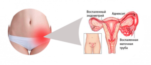 Как определить воспаление яичников у женщин