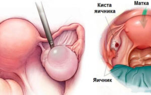 Как вылечить кисту яичника