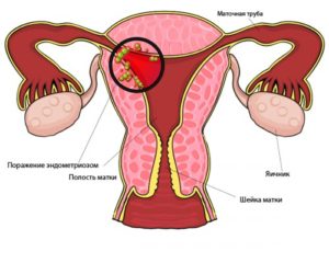 Можно ли забеременеть при эндометриозе и миоме матки