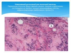 Инвазивный дольковый рак молочной железы 2 степени злокачественности