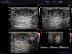 Сонография молочных желез что это такое