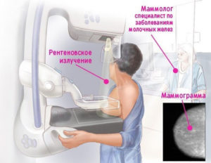 В какой период делают маммографию молочных желез