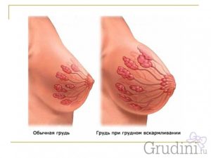 Болит молочная железа при лактации