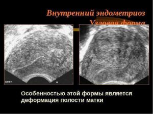 Эндометриоз внутренний диффузная форма
