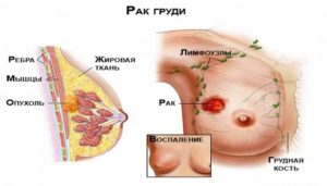 Уплотнение в молочной железе в виде шарика у женщин что это