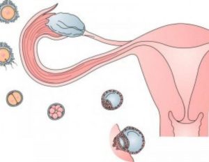 Можно ли забеременеть с одним яичником и одной трубой