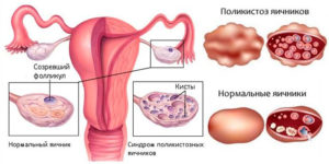 Поликистоз яичников симптомы и лечение у девочек