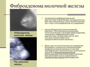 Как отличить фиброаденому молочной железы от рака