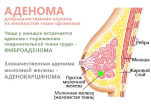 Аденома фиброма молочной железы