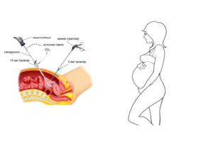 Беременность после каутеризации яичников