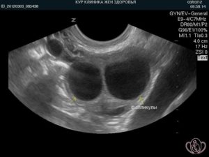 Два доминантных фолликула в одном яичнике