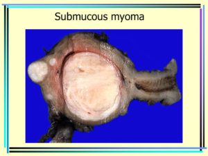 Субмукозная миома матки 2 типа
