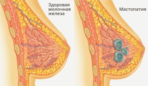 Лечение кисты молочной железы без операции