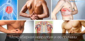 Межреберная невралгия отдает в молочную железу