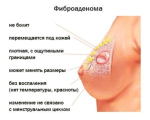 Чем лечить фиброаденому молочной железы