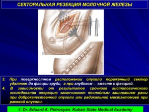 Удаление фиброаденомы молочной железы секторальная резекция