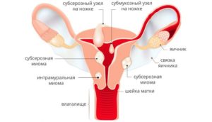 Миома шейки матки допустимые размеры