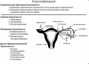 Можно ли забеременеть с одним яичником и одной трубой