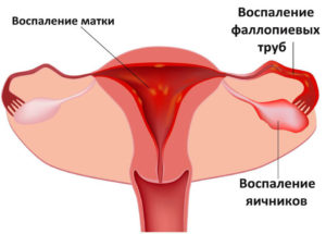 Воспаление яичников у женщин чем лечить