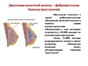 Диагноз фкм молочной железы что это такое