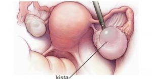 Киста яичника ретенционная лечение