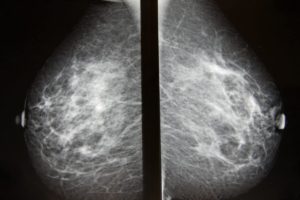 Маммография рак молочной железы