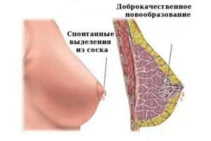 Прозрачная жидкость из молочных желез при беременности