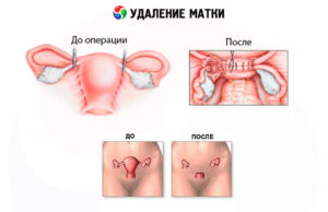 Могут ли быть выделения после удаления матки и яичников