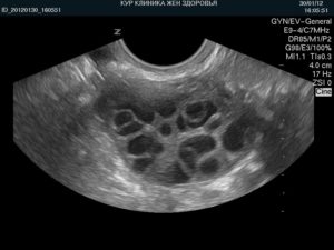 Сколько должно быть фолликулов в яичнике