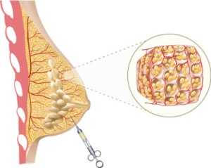 Липофилинг молочной железы как долго эффект