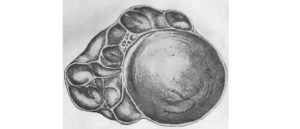 Двухкамерная киста левого яичника