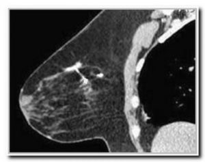 Компьютерная томография молочных желез