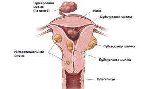 Миома влагалища