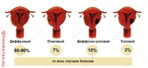 Диффузный эндометриоз матки