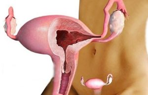 Миома матки гиперплазия эндометрия