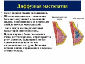 Диффузные изменения молочной железы что это такое